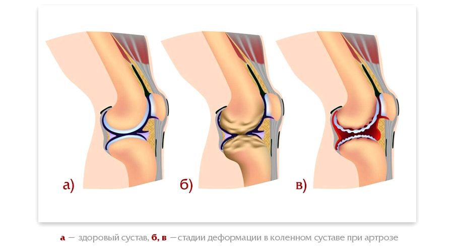 Профилактика заболеваний суставов