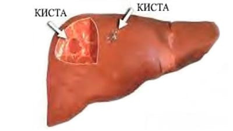 Консервативное лечение кисты печени