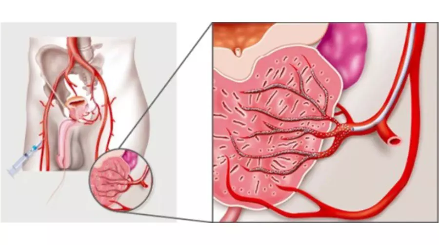 Подготовка к процедуре лазерной энуклеации аденомы простаты