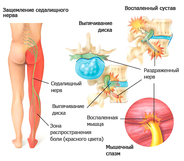 Профилактика повторного возникновения проблем с седалищным нервом