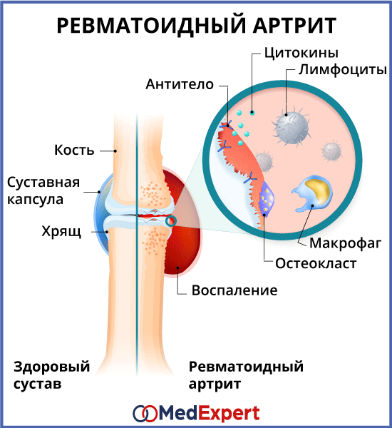 Курение как фактор риска для развития ревматоидного артрита