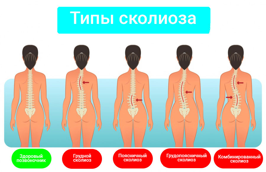 Последствия сколиоза: ограничение движения и деформация позвоночника