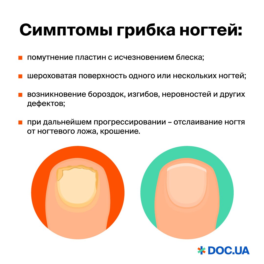 Симптомы и признаки грибка на руках и ногах