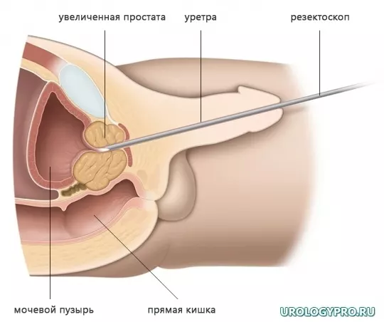 Показания для лазерной энуклеации аденомы простаты