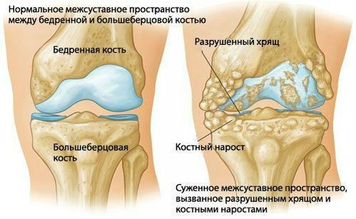 Характерные симптомы остеопороза коленного сустава