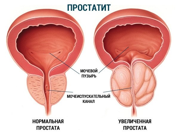 Профилактика вирусного простатита
