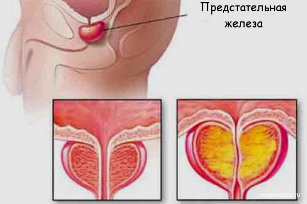 Нарушение эрекции