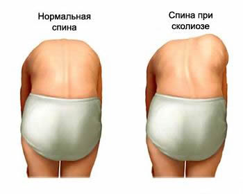 Возможные причины сколиоза