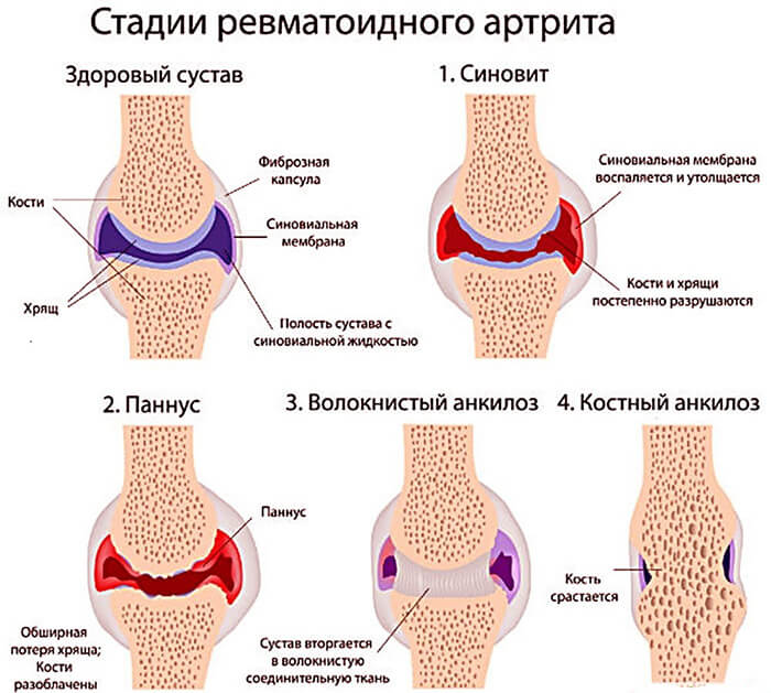 Первые признаки и симптомы ревматоидного артрита у женщин