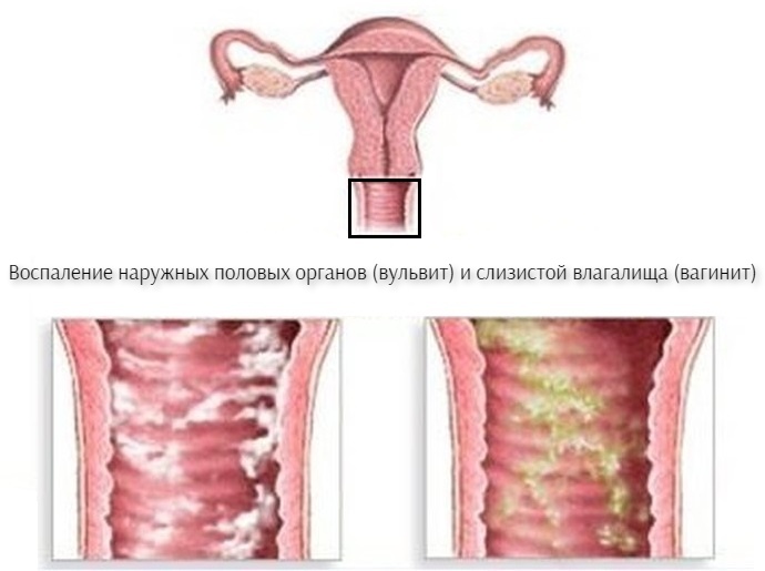 Методы лечения и облегчения отека половых губ при беременности