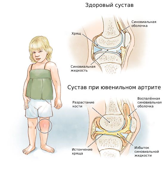 Прогноз и профилактика ювенильного идиопатического артрита