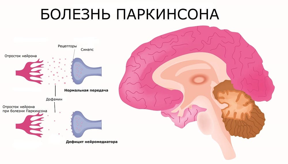 Прогноз и качество жизни пациентов с акинетико-ригидным синдромом