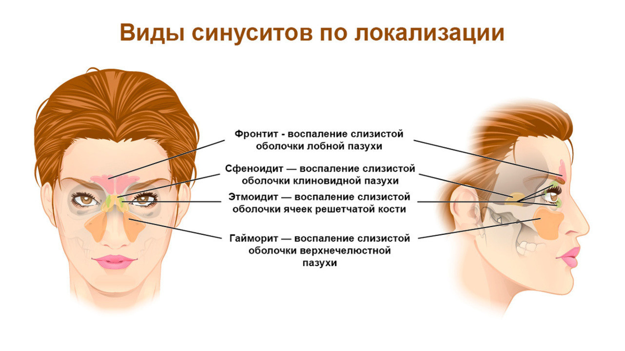 Лечение острого катарального гайморита у взрослых