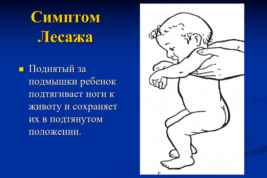 Что может произойти при неправильном лечении менингита у детей