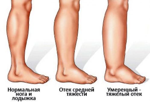 Массаж для уменьшения отечности