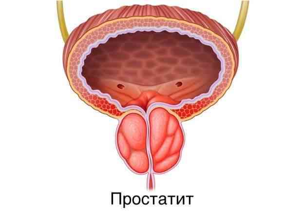Полезные советы для мужчин с диагнозом «простатит»