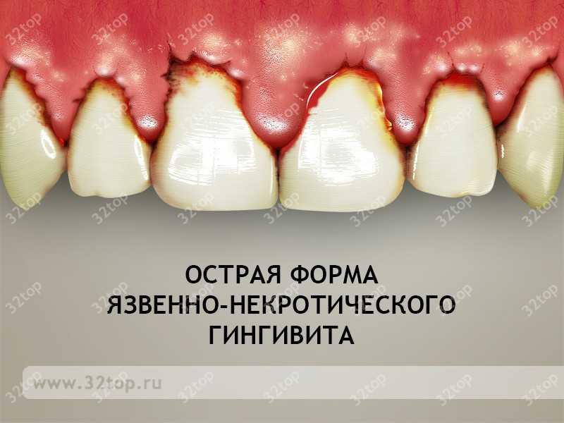 Преимущества использования мышьяка в стоматологии