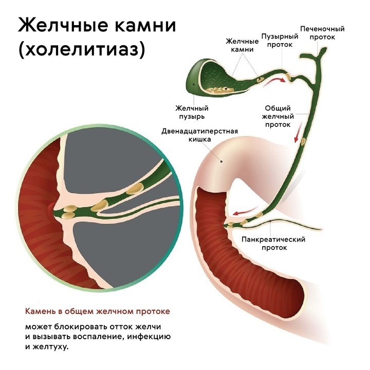 Симптомы приступа холецистита