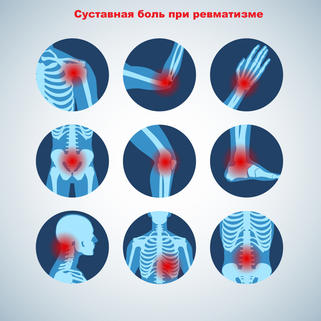 Ревматизм: последствия и контроль