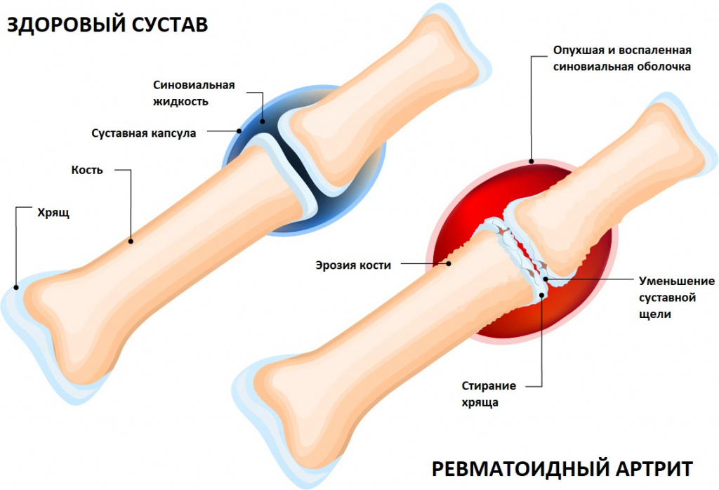 Какие заболевания можно выявить анализом на ревмопробы