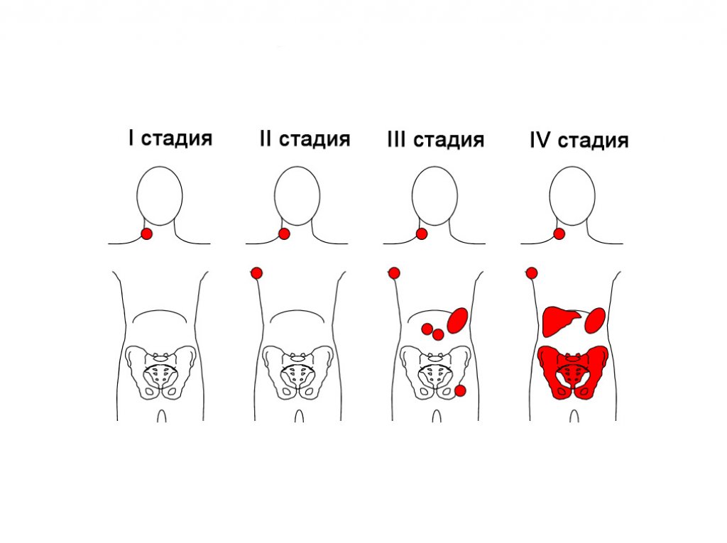 Прогрессивная потеря веса