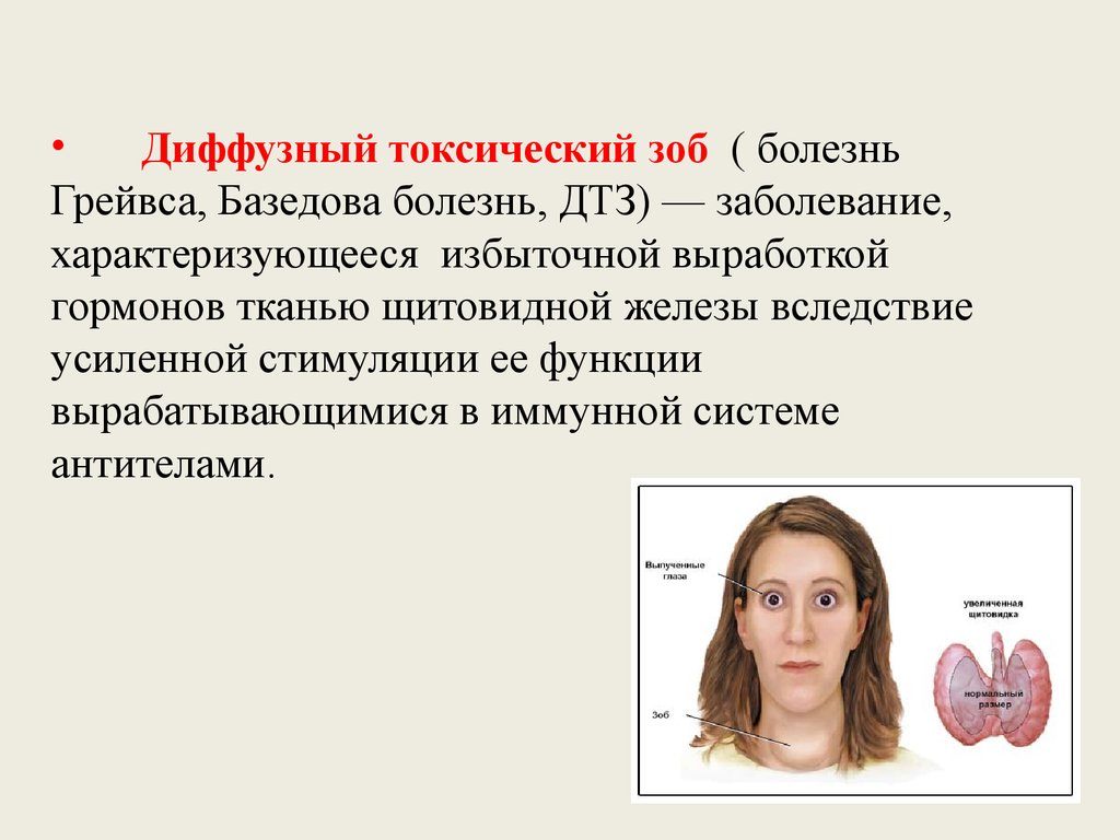 Лечение болезни Грейвса