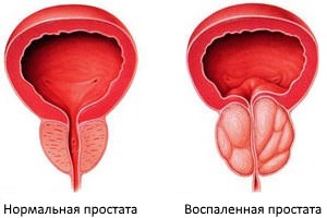 Регулярные упражнения для борьбы с простатитом и запорами