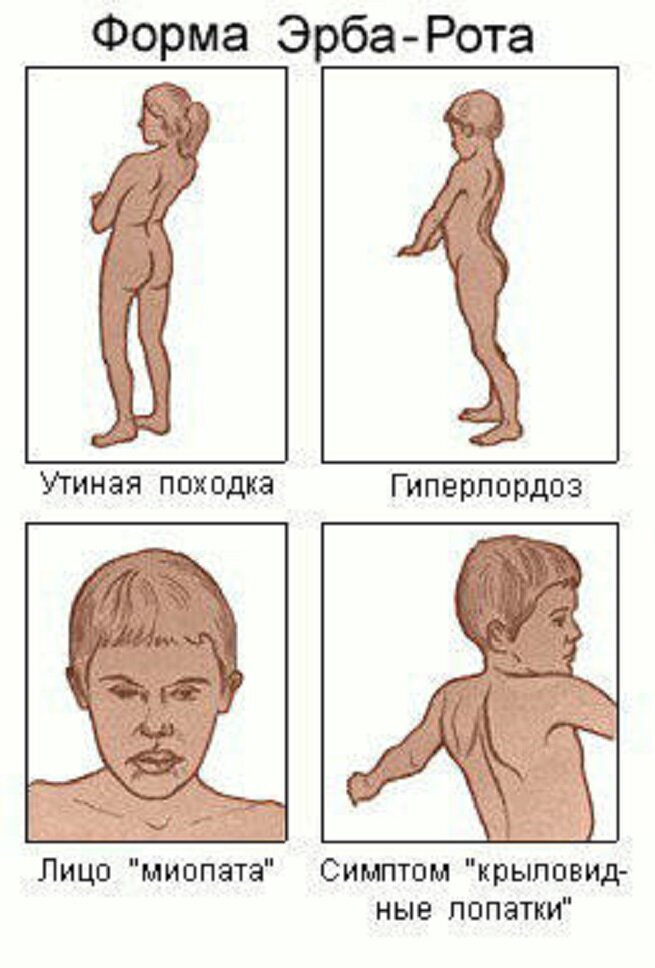 Методы диагностики миопатии Дюшенна