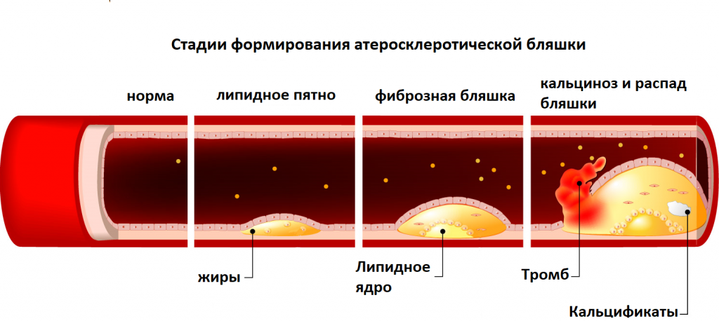Симптомы атеросклероза