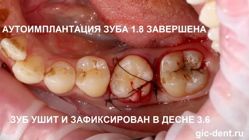Таблица: Показания к патологическому удалению зубов мудрости