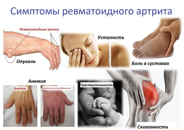 Основные группы препаратов при лечении артрита