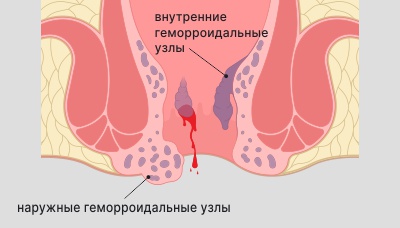 Симптомы тромбоза геморроидального узла