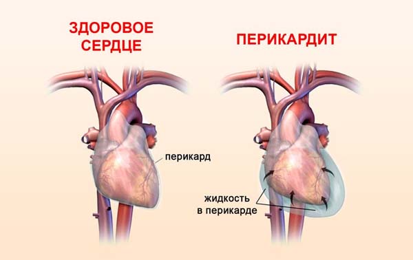 2. Хронический перикардит