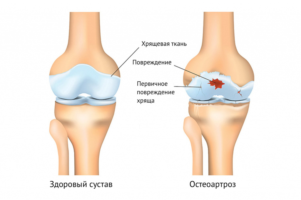 Эндопротезирование плечевого сустава