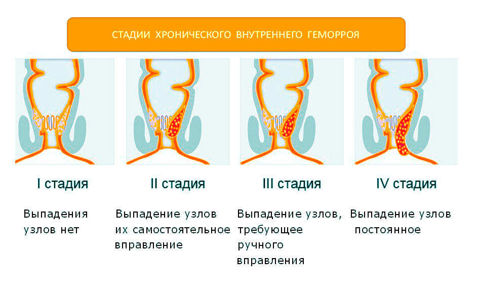 Симптомы геморроя 4 степени
