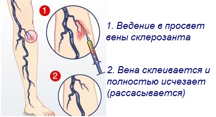Последствия и осложнения после склеротерапии вен ног