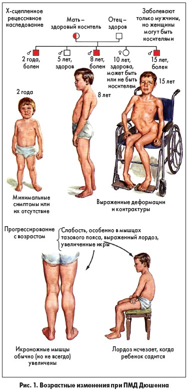 Как улучшить качество жизни пациентов с миопатией Дюшенна?