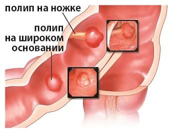 Причины образования слизи в желудке