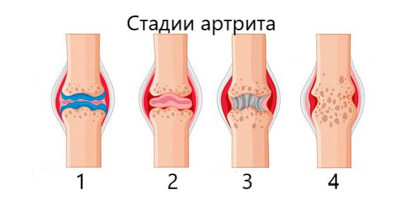 Методы лечения артрита у детей