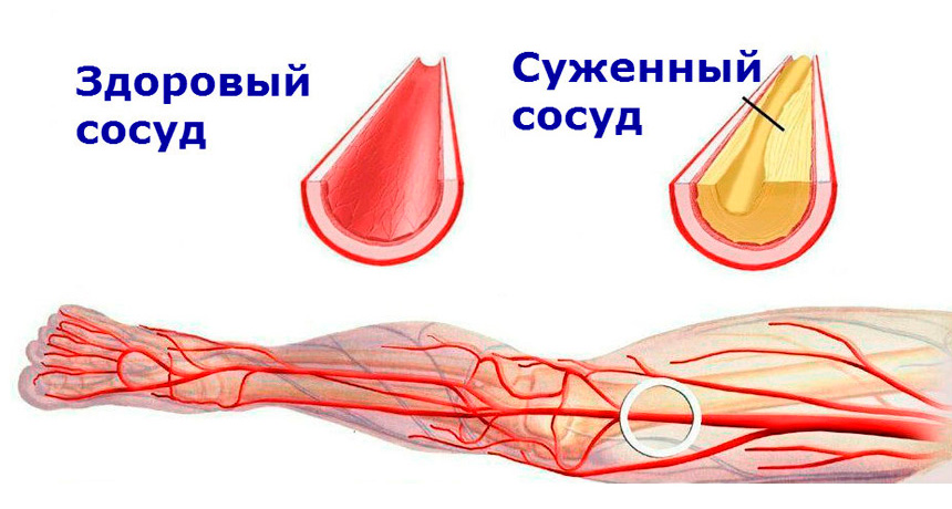 Причины развития атеросклероза
