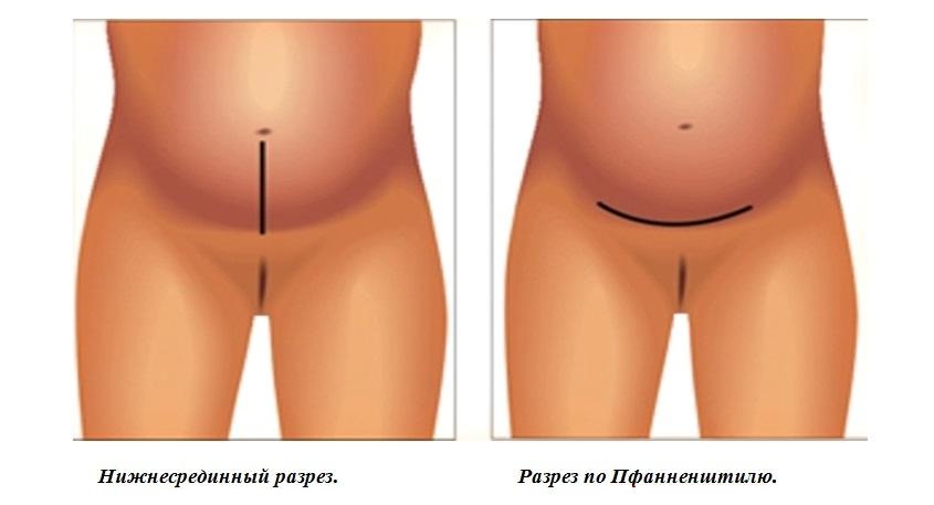 Лапаротомия кисты яичника: основные аспекты процедуры