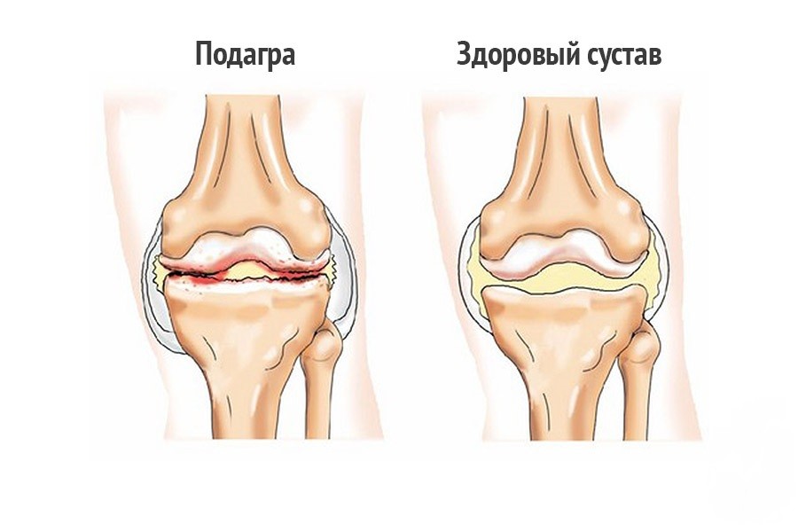 Подагра коленного сустава: симптомы болезни и методы лечения