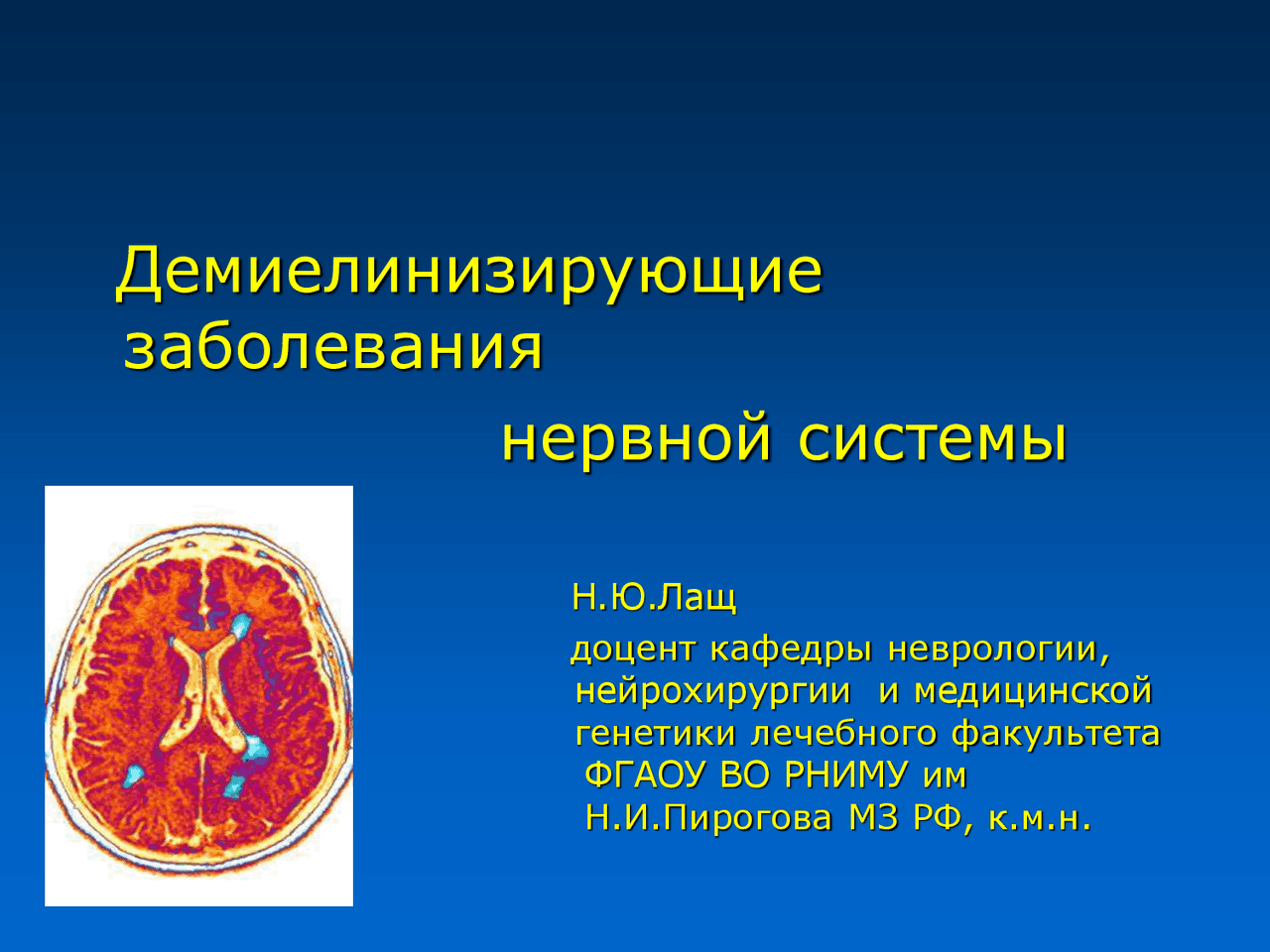 Симптомы и диагностика демиелинизирующих заболеваний нервной системы и головного мозга