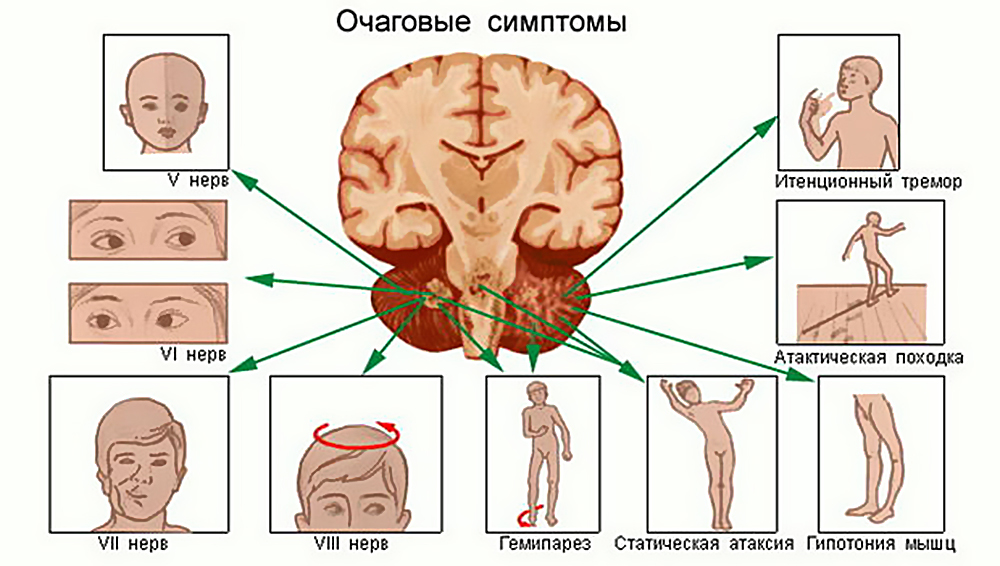 Лечение опухоли мозга