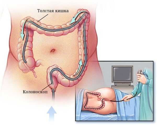 Подраздражение кожи