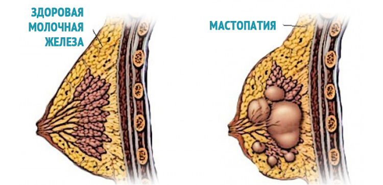 Лечение фиброзно-кистозной мастопатии