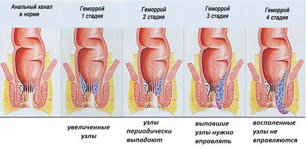Компликации геморроя 4 степени