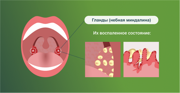 Лекарственное лечение хронического тонзиллита
