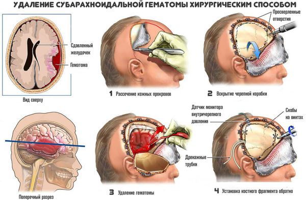 Как убрать гематому после ушиба