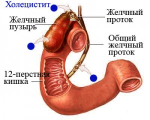 Профилактика хронического холецистита
